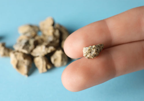 Kidney Stones
