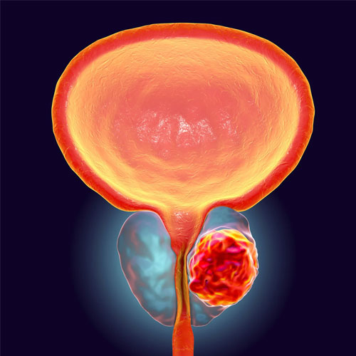 Prostate Cancer